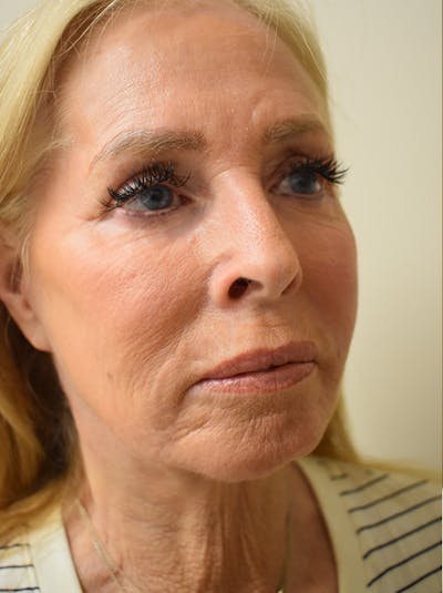 Facelift Before & After Gallery - Patient 141102 - Image 4