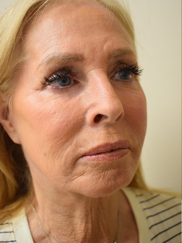 Facelift Before & After Gallery - Patient 141102 - Image 4
