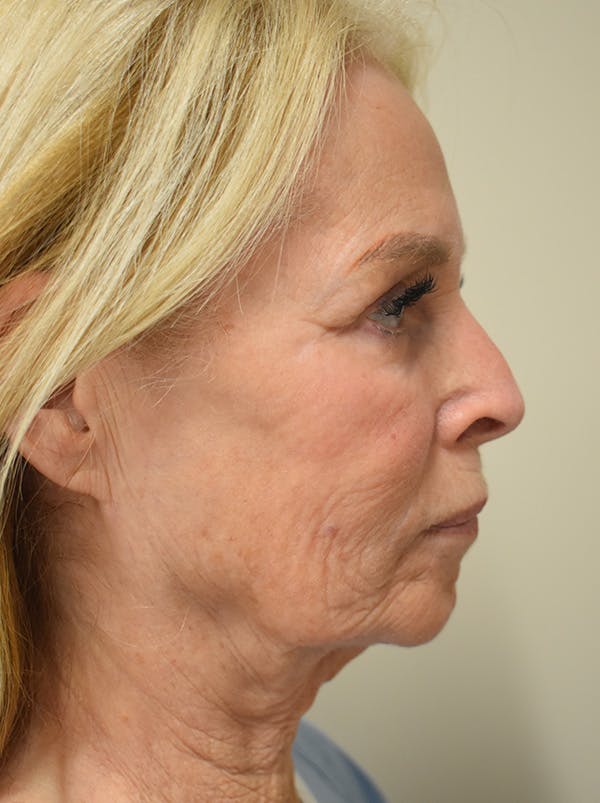 Facelift Before & After Gallery - Patient 141102 - Image 5