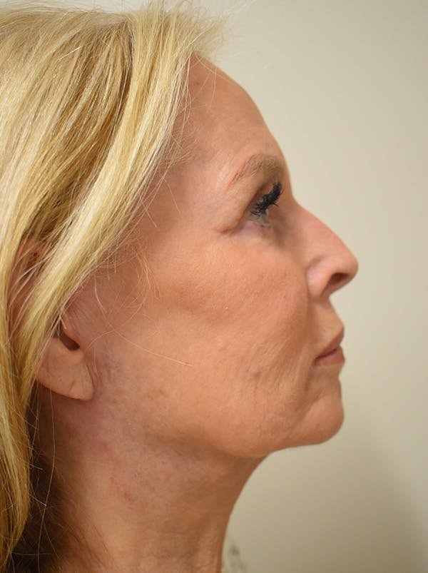 Facelift Before & After Gallery - Patient 141102 - Image 6