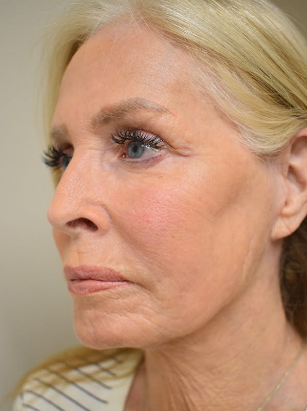 Facelift Before & After Gallery - Patient 141102 - Image 8