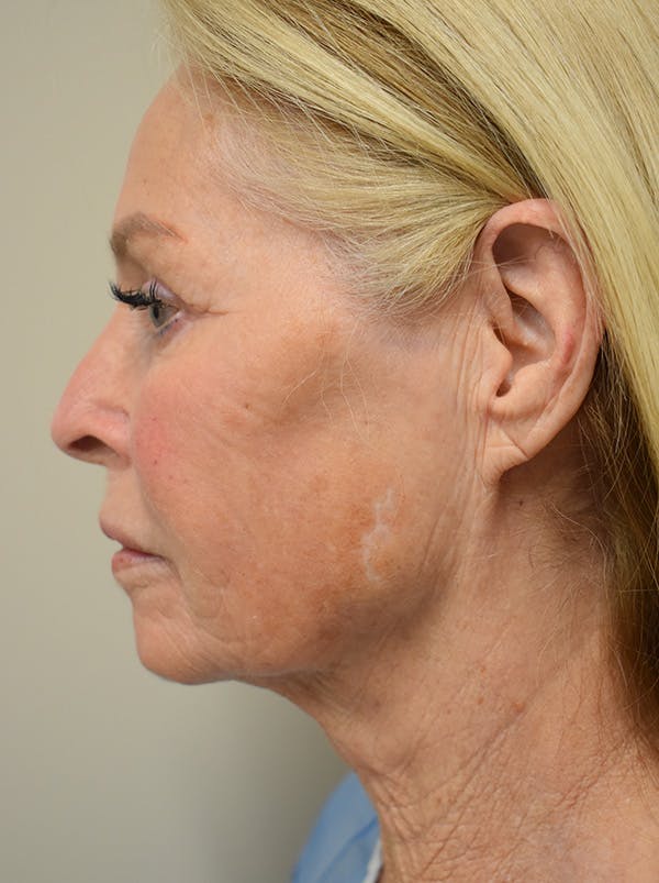 Facelift Before & After Gallery - Patient 141102 - Image 9