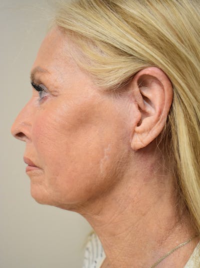 Facelift Before & After Gallery - Patient 141102 - Image 10