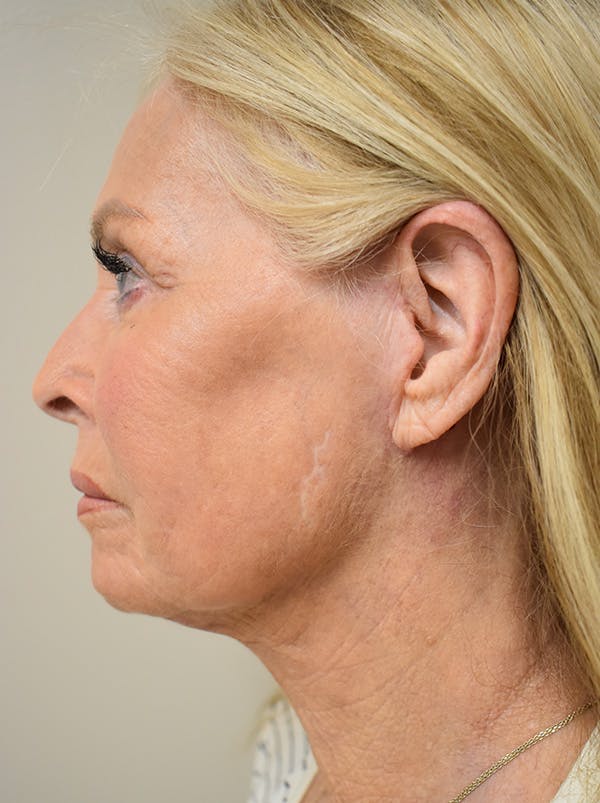 Facelift Before & After Gallery - Patient 141102 - Image 10