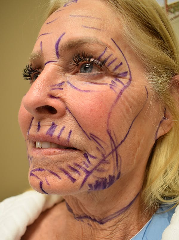 Facelift Before & After Gallery - Patient 141102 - Image 7