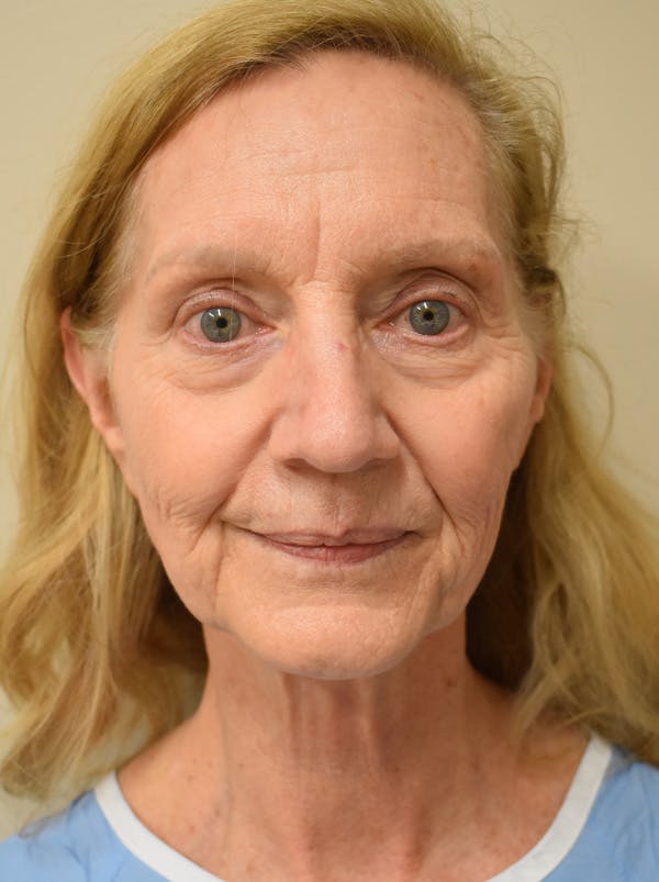 Facelift Before & After Gallery - Patient 326927 - Image 1