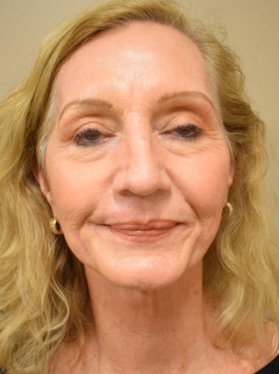 Facelift Before & After Gallery - Patient 326927 - Image 2