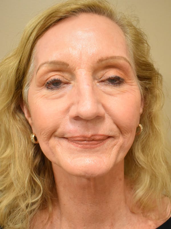 Facelift Before & After Gallery - Patient 326927 - Image 2