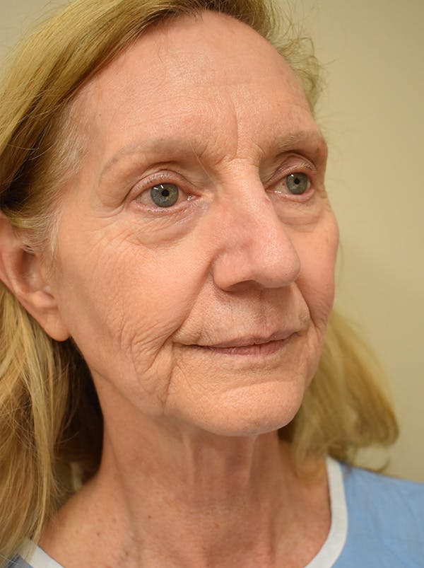 Facelift Before & After Gallery - Patient 326927 - Image 7