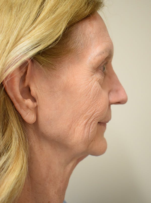 Facelift Before & After Gallery - Patient 326927 - Image 9