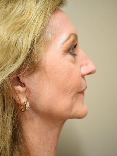 Facelift Before & After Gallery - Patient 326927 - Image 10