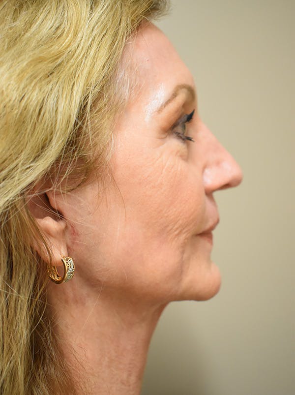 Facelift Before & After Gallery - Patient 326927 - Image 10