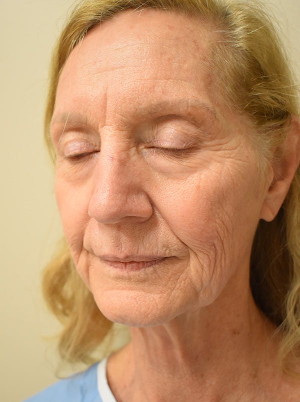 Facelift Before & After Gallery - Patient 326927 - Image 3