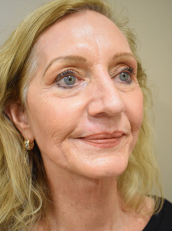 Facelift Before & After Gallery - Patient 326927 - Image 8