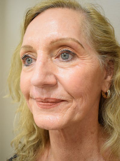 Facelift Before & After Gallery - Patient 326927 - Image 4