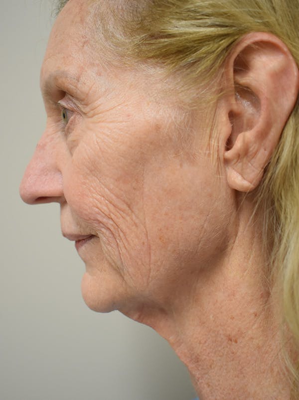 Facelift Before & After Gallery - Patient 326927 - Image 5