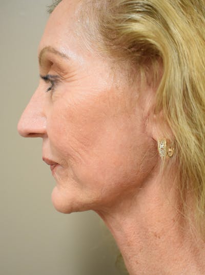 Facelift Before & After Gallery - Patient 326927 - Image 6
