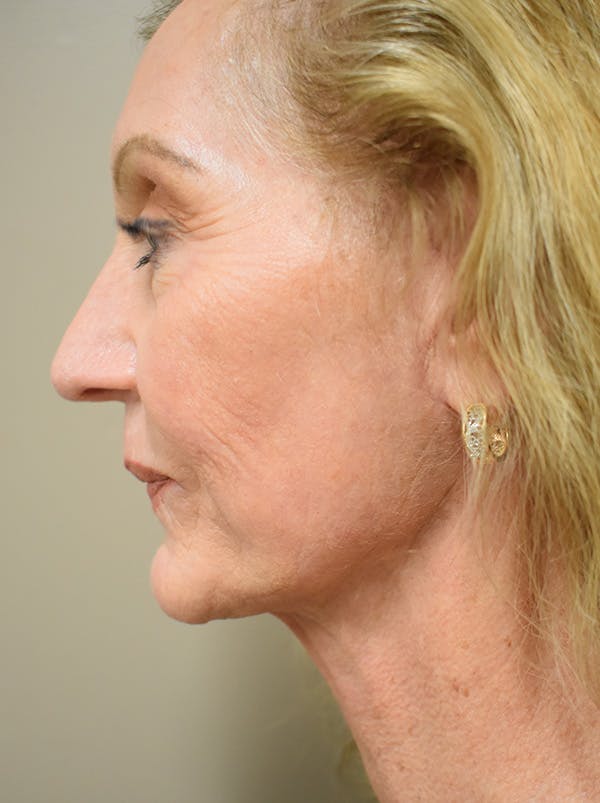Facelift Before & After Gallery - Patient 326927 - Image 6