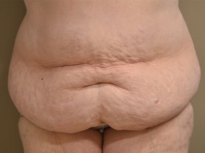 Tummy Tuck Before & After Gallery - Patient 278378 - Image 1