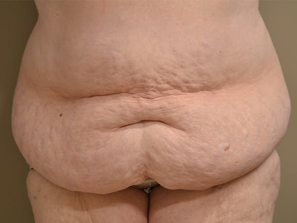 Tummy Tuck Before & After Gallery - Patient 278378 - Image 1