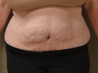 Tummy Tuck Before & After Gallery - Patient 278378 - Image 2