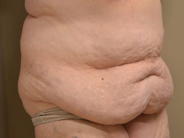 Tummy Tuck Before & After Gallery - Patient 278378 - Image 3