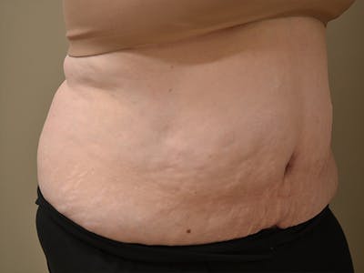 Tummy Tuck Before & After Gallery - Patient 278378 - Image 4