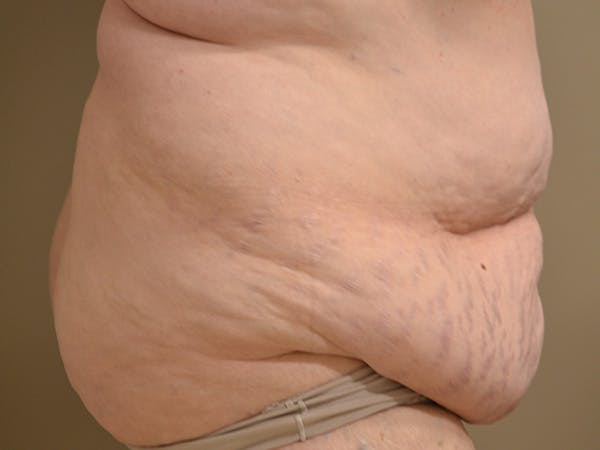 Tummy Tuck Before & After Gallery - Patient 278378 - Image 5