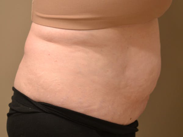 Tummy Tuck Before & After Gallery - Patient 278378 - Image 6