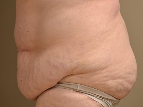 Tummy Tuck Before & After Gallery - Patient 278378 - Image 7