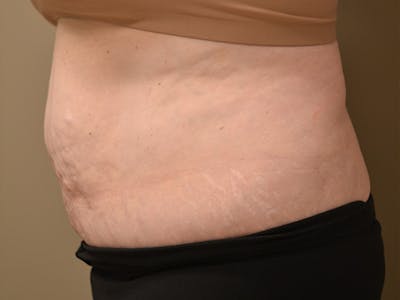 Tummy Tuck Before & After Gallery - Patient 278378 - Image 8