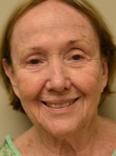 Facelift Before & After Gallery - Patient 529330 - Image 1