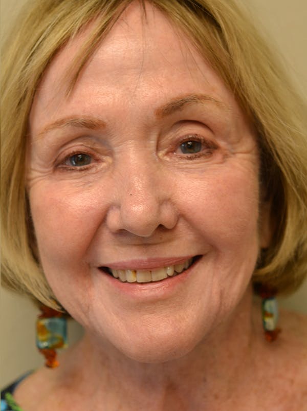 Facelift Before & After Gallery - Patient 529330 - Image 2