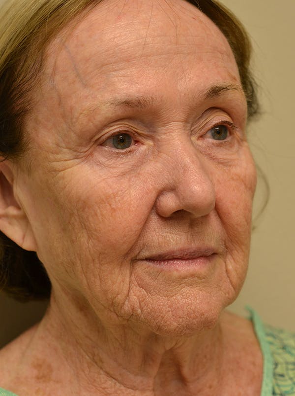 Facelift Before & After Gallery - Patient 529330 - Image 3