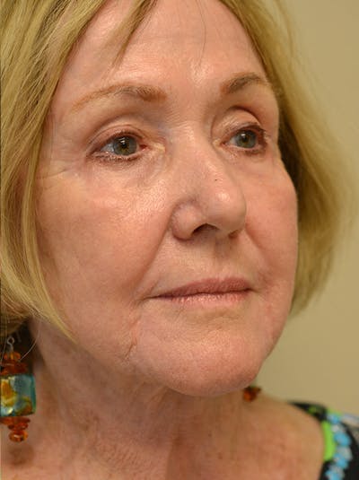 Facelift Before & After Gallery - Patient 529330 - Image 4