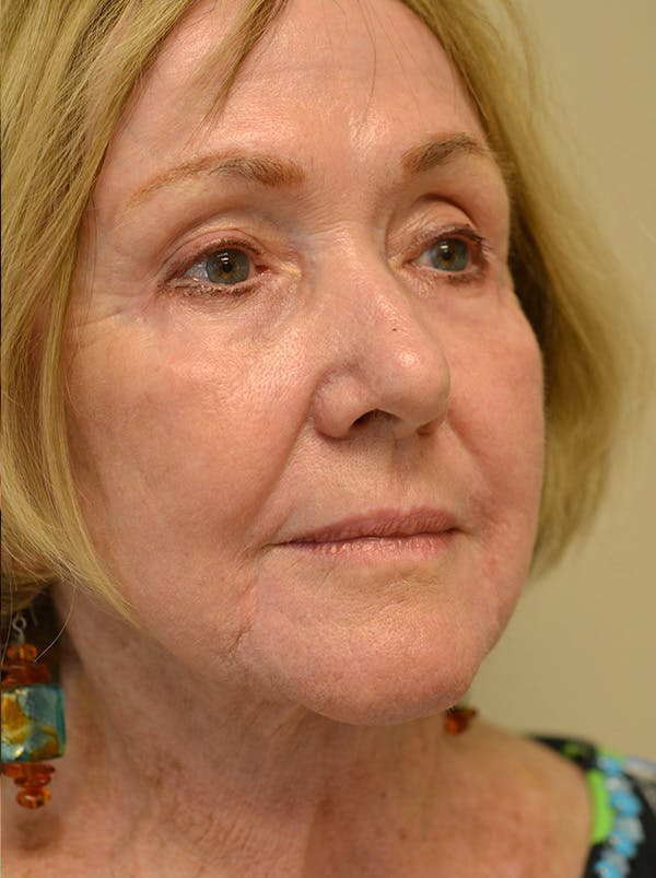 Facelift Before & After Gallery - Patient 529330 - Image 4