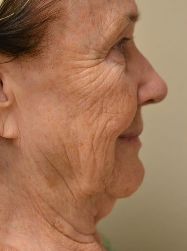 Facelift Before & After Gallery - Patient 529330 - Image 5