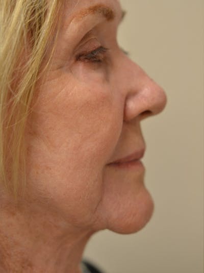 Facelift Before & After Gallery - Patient 529330 - Image 6