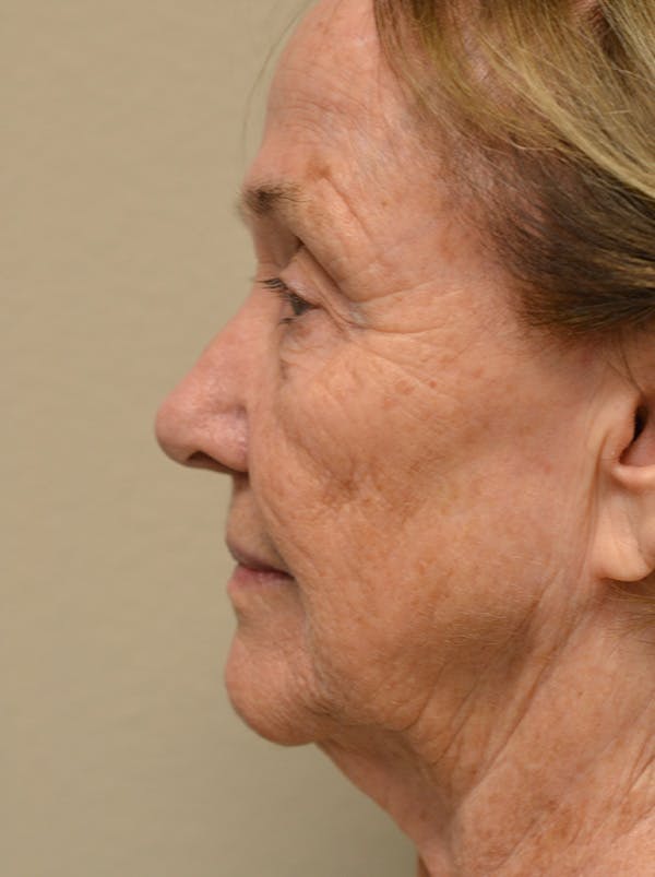 Facelift Before & After Gallery - Patient 529330 - Image 7