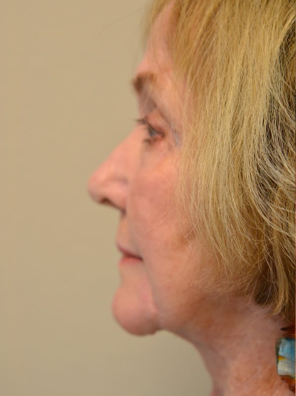 Facelift Before & After Gallery - Patient 529330 - Image 8