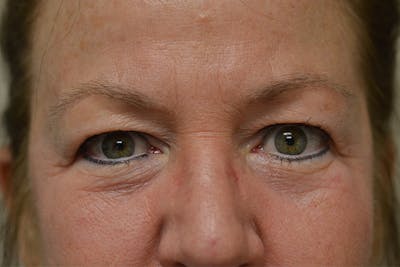 Eyelid Surgery Before & After Gallery - Patient 942366 - Image 1