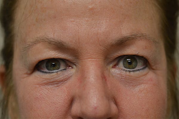 Eyelid Surgery Before & After Gallery - Patient 942366 - Image 1