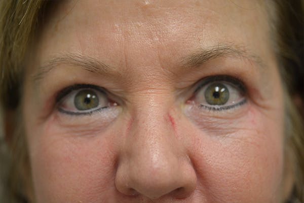 Eyelid Surgery Before & After Gallery - Patient 942366 - Image 2