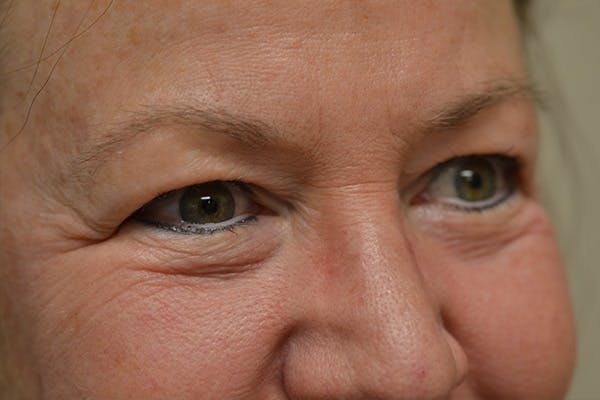 Eyelid Surgery Before & After Gallery - Patient 942366 - Image 3
