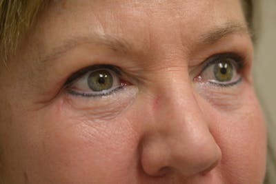 Eyelid Surgery Before & After Gallery - Patient 942366 - Image 4