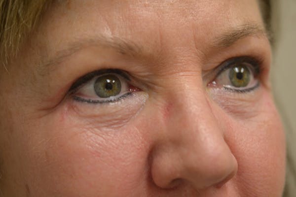 Eyelid Surgery Before & After Gallery - Patient 942366 - Image 4