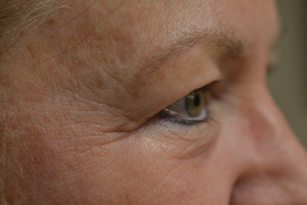 Eyelid Surgery Before & After Gallery - Patient 942366 - Image 5
