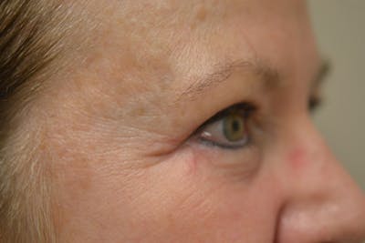 Eyelid Surgery Before & After Gallery - Patient 942366 - Image 6