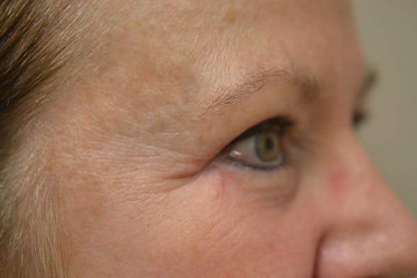 Eyelid Surgery Before & After Gallery - Patient 942366 - Image 6