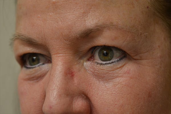 Eyelid Surgery Before & After Gallery - Patient 942366 - Image 7